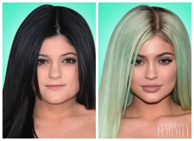 Kylie Jenner síce priznala výplne pier, no špekuluje sa aj o brade