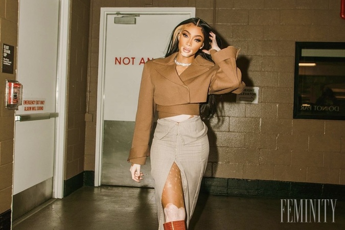Winnie Harlow búra sterotypy