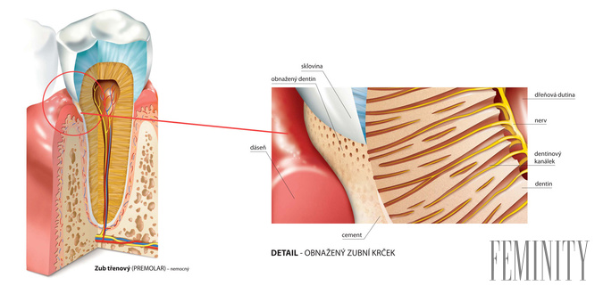 Citlivý zub s obnaženým krčkom